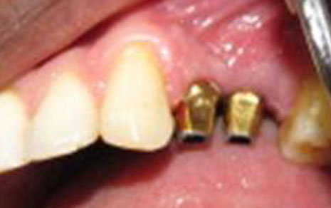 Multiple Teeth Implant Treatment