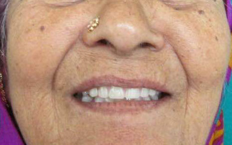 Full Mouth Implants Treatment