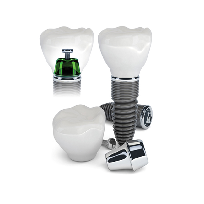 Dental Implants