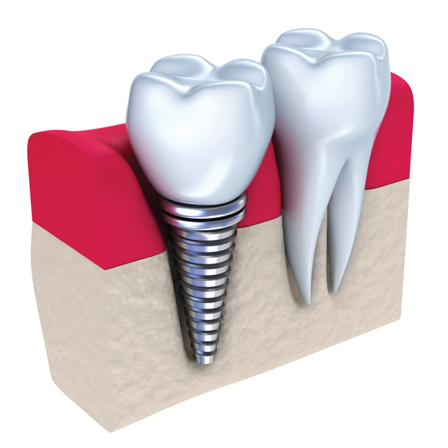 Dental Implants Treatment