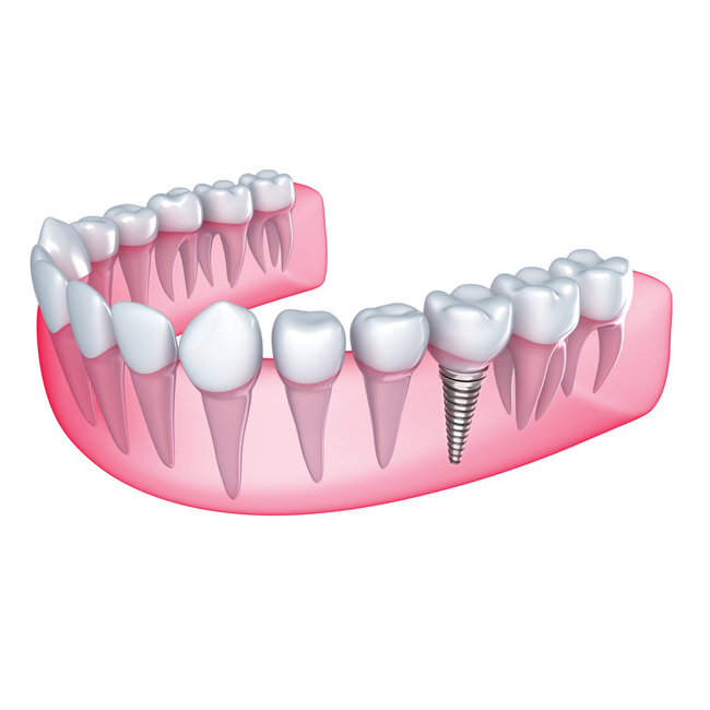 Dental Implant Cost