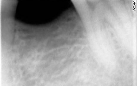 Implant – Tooth Replacement