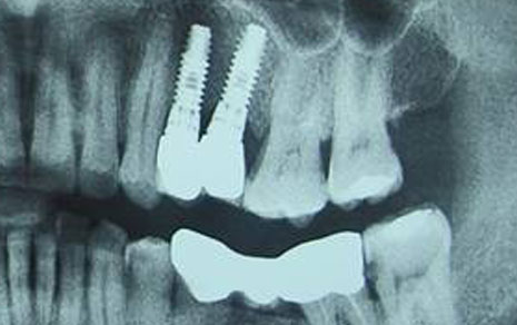 Single Tooth Implant