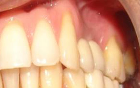 Dental Implants Surgery