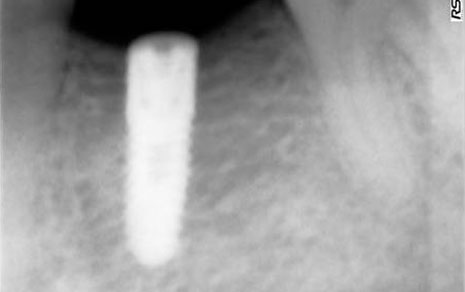 Implant Reatment Cost