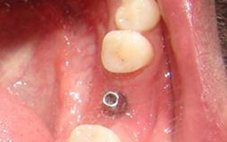 Dental Implant Delhi