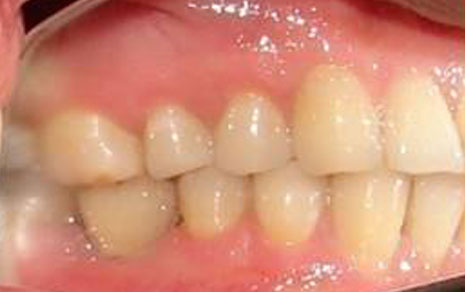 Single tooth Replacement